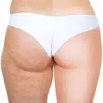 Est-ce que la graisse revient après une liposuccion