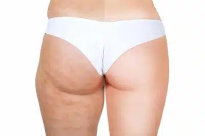 Est-ce que la graisse revient après une liposuccion