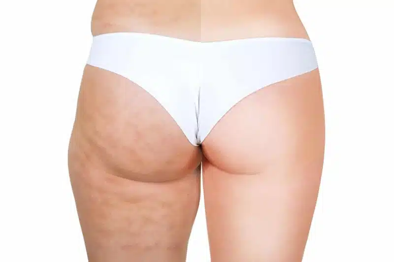Est-ce que la graisse revient après une liposuccion