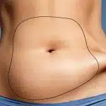 meilleur pays pour faire une liposuccion